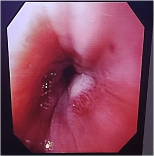 Endoscopia digestiva superior: Estenosis esofágica constrictiva del esfínter esofágico inferior.