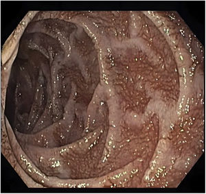 La esofagogastroduodenoscopia mostró mucosa friable con elevaciones granulares y pliegues duodenales engrosados y muy prominentes en la segunda parte del duodeno.