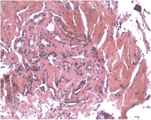 Los especímenes de biopsia mostraron depósitos amiloides teñidos de Rojo Congo, con birrefringencia verde manzana bajo luz polarizada.