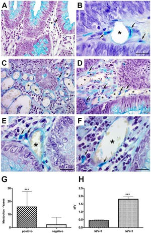 Mastocitos perivasculares en las neoplasias. A) Mastocitos en vasos pequeños cerca del epitelio glandular. B) Mastocitos cerca y dentro de la pared vascular (flechas) en adenoma. C) Distribución de mastocitos en cáncer colorrectal aislado (flecha) y D) en grupo (flechas). E) Presencia de mastocitos cerca de vasos (flechas) y F) en la pared (flechas). Tinción azul alcián; barra de escala=20μm. G) Análisis cuantitativo que muestra correlación positiva entre mastocitos cercanos a vasos y H) densidad de mastocitos en muestras de adenoma. M/V: mastocito/vaso; media: 0.44 (<1M/V), 1.90 (≥1M/V); desviación estándar: 0.25 (<1M/V), 0.91 (≥1M/V).