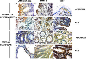 Expresión de laminina-332, MMP-9 y VEGF en neoplasias colorrectales. A) Presencia de cadena γ2 laminina-332 en el citoplasma del epitelio de revestimiento y en la membrana basal en muestra de adenoma. B) En CCR la expresión de laminina demostró la discontinuidad de la membrana basal en los sitios de invasión del tumor (*). C) Expresión discreta de laminina en el citoplasma de glándulas de adenoma. D) Expresión intensa de laminina en epitelio glandular de CCR (flechas). E) Expresión de MMP-9 en el citoplasma del endotelio de revestimiento y estroma, cerca del epitelio. F) En el CCR la expresión de MMP-9 fue en el citoplasma de cúmulos de células malignas invasivos (flechas). G) El citoplasma de glándulas de adenoma mostró expresión de MMP-9 en pocas células. H) La mayoría de las glándulas alteradas en CCR presentaron expresión de MMP-9 en el citoplasma. I) La expresión de VEGF en el adenoma fue observada en el citoplasma del epitelio de revestimiento y en células estromales. El endotelio de los vasos estromales también presentó inmunotinción. J) En el CCR la expresión de VEGF se encontró en áreas de desorganización de la interfaz entre el epitelio y el tejido conectivo. K) El VEGF fue expresado discretamente en glándulas en adenoma al ser comparadas con glándulas en CCR. L) La neoplasia maligna también presentó vasos con expresión de VEGF. Inmunohistoquímica: barra de escala=20μm.