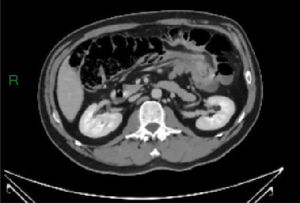 TC abdominal que muestra una intususcepción colo-colónica.