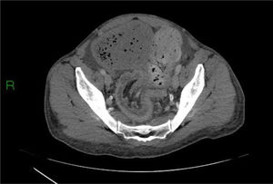 TC abdominal que muestra una intususcepción colorrectal.