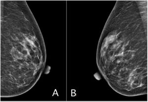 Imágenes radiológicas de las mamografías de mama izquierda (A) y de mama derecha (B). Se observa la simetría entre ambas mamas, con adecuada distribución del tejido glandular y sin presencia de distorsiones en la arquitectura ni calcificaciones sospechosas. Piel y complejo del pezón sin alteraciones.