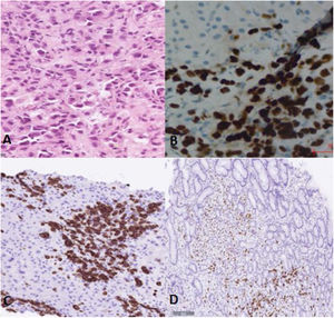 Imágenes histológicas de las biopsias de hígado y estómago (20x). (A) Sección de biopsia de hígado con tinción de hematoxilinaeosina, infiltrado difuso de células de carácter neoplásico a nivel de los espacios porta y sinusoides periportales. (B) Sección de biopsia de hígado con técnicas de inmunohistoquímica, infiltración en el parénquima hepático por células tumorales que expresan positividad para GATA-3. (C) Sección de biopsia de hígado con técnicas de inmunohistoquímica, infiltración en parénquima hepático por células tumorales que expresan positividad para citoqueratina 7. (D) Sección de biopsia de estómago con técnicas de inmunohistoquímica, infiltración en mucosa gástrica por células tumorales que expresan positividad para receptores de estrógeno.