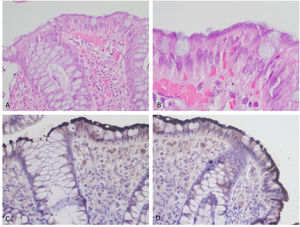Biopsia de mucosa colónica tomada en estudio endoscópico. A)Mucosa colónica con infiltrado linfocítico inespecífico en la lámina propia, en la superficie borrosa o difuminada (10×,H&E). B)Superficie mucosa con aspecto de borde en cepillo (100×, H&E), tinción de hematoxilina y eosina. C,D)La tinción de inmunohistoquímica para treponema resalta las espiroquetas sobre la superficie epitelial (40×).