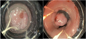 Panendoscopia. A) Visualización de vaso a 32cm de la arcada dentaria superior. B) Ligadura exitosa del vaso esofágico visible.