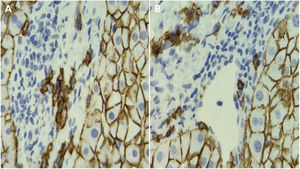 Tejido hepático teñido con inmunohistoquímica CD138. A) Se muestran las células plasmáticas. B) Se muestra el espacio portal hepático.