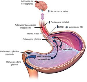 Mecanismos fisiopatológicos de la enfermedad por reflujo gastroesofágico. EEI: esfínter esofágico inferior; RTEEI: relajaciones transitorias del EEI.
