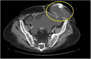 Tomografía computarizada de abdomen con contraste intravenoso donde se observa cianoacrilato en el estoma.