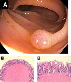 A)Pólipo sésil de 9mm detectado en el colon transverso durante la colonoscopia. B)Hematoxilina y eosina, magnificación de 40×. Mucosa de colon con proliferación de músculo liso sugerente de leiomioma. C)Hematoxilina y eosina, magnificación de 200×. El leiomioma se compone de células benignas de músculo liso con citoplasma rosa denso, ordenadas en fascículos cruzados. No existe actividad mitótica, necrosis o atipia sugerente de tumor maligno de músculo liso (es decir, leiomiosarcoma).