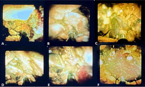 (A-F): Litotricia electrohidráulica utilizando colangioscopio SpyGlass Discover (Boston Scientific, Natick, Massachusetts, EE. UU.)