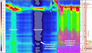 MEAR con impedancia de paciente con acalasia tipo II, postoperado de miotomía de Heller y funduplicatura tipo Nissen, en reabordaje por disfagia esofágica. Se observa en el panel A el topograma de presión al realizar las maniobras de espiración e inspiración para la localización de los puntos de referencia sin que se puedan observar el esfínter esofágico inferior ni la crura diafragmática. En el panel B se observa la ausencia de aclaramiento esofágico.