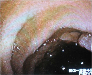 Pólipo duodenal.