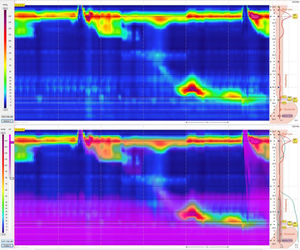 Deglución de trago húmedo de 5ml en manometría de alta resolución/impedancia en paciente con sospecha de rumiación. No se observan datos que sugieran el diagnóstico de síndrome de rumiación.