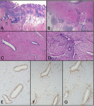 Anatomía patológica del caso clínico. A,B (HE 100×): se observa infiltrado inflamatorio linfocitario transmural en la mucosa intestinal. C,D (HE 200×): zona de estenosis; se identifican glándulas y estroma de tipo endometrial. E,F)corresponde a las tinciones de inmunohistoquímica para PAX 8 y receptores de estrógenos. G)corresponde a la tinción para CD20.