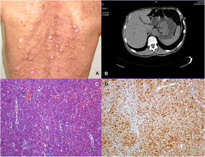 A)Imagen de un paciente que muestra múltiples neurofibromas y manchas café claro en la espalda. B)Tomografía computarizada que documenta una masa endoluminal de 7.8×5.2cm en el estómago. C)Variante epitelioide de TEGI (H&E, ×100). D)Inmunohistoquímica de células tumorales (DAB, ×100) que muestra inmunorreactividad membranosa difusa para CD117/KIT.