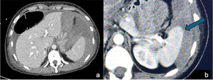 a) TC que muestra hemoperitoneo; b) TC en fase arterial que demuestra el sitio DE (flecha azul).