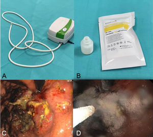 Esquema demostrativo del uso de EndoClot™. A) Componentes del sistema de aplicación. B) Frasco con 2g del polvo hemostático. C) Hemorragia digestiva de origen tumoral en capa. D) Hemostasia posterior a la aplicación del polvo.