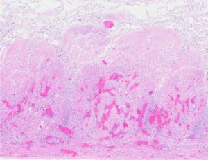 Histología de biopsias gástricas con inflamación y necrosis agudas de la mucosa y submucosa.