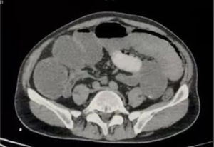 Corte axial: evidencia de zona de transición a nivel de íleon distal con niveles hidroaéreos y edema de pared intestinal.