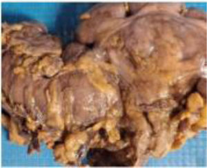 Segmento de íleon: espécimen de tejido conformado por íleon terminal, válvula ileocecal, apéndice cecal y ciego (colon). Se identifica una zona de estenosis localizada a 5.0cm del límite proximal y a 6.0cm del límite distal, ubicada en la unión del íleon terminal con la válvula ileocecal de 3.0×2.0cm que causa obstrucción del 95% de la luz.