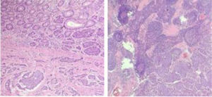 Lesión neoplásica epitelial con patrón de crecimiento organoide y trabecular conformada por células que forman sincitios con disposición central del núcleo, el cual presenta cromatina fina que hace evidente un nucléolo central.