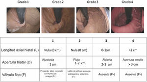 La clasificación de la American Foregut Society de integridad de la unión esofagogástrica.