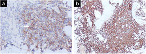 a)Biopsia de médula ósea donde se observa expresión alta de CD138 (×400), lo cual indica una presencia significativa de células plasmáticas. Las células señaladas con la flecha blanca se identifican como células plasmáticas, las cuales son características de trastornos de células plasmáticas. b)Biopsia de médula ósea donde se observa expresión de cadena ligera lambda (×200), lo cual apoya el diagnóstico de proliferación de célula plasmática monoclonal, una característica distintiva del mieloma múltiple.