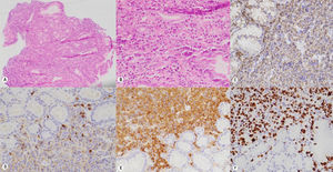 Histopatología e inmunohistoquímica. A,B)Hematoxilina eosina. Los cortes muestran mucosa gástrica con expansión de la lámina propia dado por denso infiltrado linfoplasmocitario, el cual infiltra el epitelio glandular y superficial. C-F)El infiltrado inflamatorio es positivo para CD138; KI67 muestra restricción para cadena lambda.
