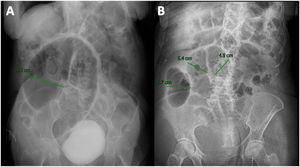 Mujer de 77 años con pseudo-obstrucción intestinal aguda al momento del diagnóstico (A) y a las 48h de tratamiento conservador (B), presentando mejoría radiológica evidente con disminución de la dilatación colónica.