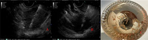 A)Biopsia de cuerpo de páncreas por abordaje transgástrico. B)Biopsia de cabeza de páncreas por abordaje transduodenal. C)Tejido pancreático obtenido.