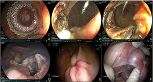 Gastroenteroanastomosis por técnica de cortes radiados. A) Colocación inicial de Hot Axios™. B y C) Realización de cortes radiados con colocación de clips de seguridad a 15 días. D) Retiro de prótesis a 30 días y estado de la gastroenteroanastomosis. E y F) Evaluación final a 60 días, observando una retracción cicatricial por el lado mucoso gástrico, y con adherencia de epiplón y parte del asa intestinal a nivel de la gastroenteroanastomosis.