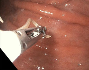 Retirada de larva con pinza.