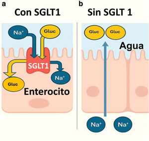 a) Transportador SGLT 1: realiza el transporte activo en el enterocito de glucosa y galactosa contra un gradiente de concentración desde la luz intestinal hacia el enterocito. La energía requerida para hacer posible este transporte la adquiere del cotransporte de sodio en la misma dirección; b) ausencia del transportador SGLT 1: Al no absorberse glucosa ni galactosa, estos azúcares permanecen en la luz intestinal y arrastran agua por efecto osmótico, conduciendo a diarrea osmótica y deshidratación grave3. El resultado neto es una pérdida mayor de agua que de sodio, lo que concentra el sodio plasmático, llevando a hipernatremia.