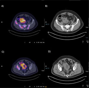 Tomografía por emisión de positrones (PET-TC) de un paciente con linfoma de Burkitt. Se observan áreas de hipermetabolismo en la región ileocecal y en estructuras adyacentes con un valor de captación SUV máximo de 13.42, indicativo de alta actividad metabólica compatible con infiltración tumoral activa. Las imágenes de fusión (paneles A y C) revelan un marcado contraste en la captación de FDG, sugiriendo compromiso neoplásico. En los cortes axiales de tomografía simple (paneles B y D) se identifica engrosamiento de las paredes intestinales.