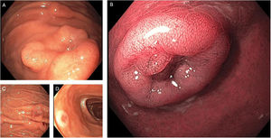 Endoscopía de linfoma con compromiso gástrico y duodenal. En la curvatura menor (A) se identifican lesiones nodulares elevadas con ulceración central, conocidas como lesiones «en volcán» (near focus). B)Misma lesión con imagen de banda estrecha (NBI) y near focus, donde se observa distorsión del patrón vascular y mucoso. C)Vista panorámica con luz blanca de la curvatura mayor, con múltiples lesiones nodulares de distintos tamaños, algunas con centro ulcerado. D)Lesión redonda solitaria en la segunda porción del duodeno, con depresión central.