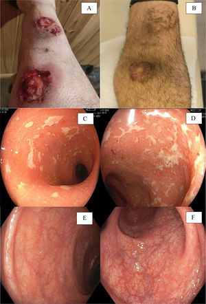 A) Imagen del caso1, previo a la terapia combinada. B)Caso1, posterior a la inducción de terapia combinada. C,D)Caso3: compromiso colónico previo al inicio de la terapia combinada avanzada (tofacitinib - infliximab). E,F)Caso3 en remisión endoscópica postinducción con terapia combinada avanzada (tofacitinib - infliximab).