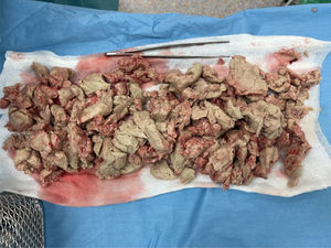 Quiste sebáceo de aproximadamente 1kg.