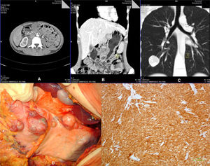 Vista axial (A) y vista coronal (B) de la TC abdominal con contraste donde se observan tumores multifocales en la parte distal del estómago. C)La TC torácica muestra una masa bien delimitada compatible con condroma pulmonar. D)Múltiples tumores nodulares en el antro gástrico. E)Células tumorales positivas para anticuerpo anti-CD117 (×100).