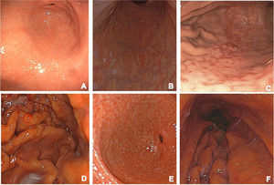 Clasificación endoscópica de Kyoto: A) Mucosa de aspecto normal: presenta pliegues regulares y una apariencia sana. B) Mucosa atrófica: se observa un adelgazamiento notable de la mucosa, pérdida de glándulas gástricas y áreas de palidez, lo que sugiere un daño significativo y riesgo potencial de malignidad. C) Metaplasia: la mucosa muestra un aspecto rugoso, indicando cambios celulares que pueden ser precoces en el desarrollo de cáncer. D) Pliegues gástricos prominentes y engrosados: este hallazgo es típico de gastritis activa y puede estar asociado con H. pylori. E) Nodularidad: áreas elevadas o nodulares en la mucosa, que son indicativas de inflamación crónica y riesgo de cáncer. F) Eritema: enrojecimiento difuso de la mucosa, lo que refleja una inflamación activa y puede estar asociado con la presencia de H. pylori.