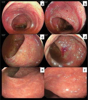 Imágenes de colonoscopia antes (a-d) y después del inicio de upadacitinib (e-f). a) Colon descendente. b) Mucosa erosionada del colon descendente. c) Recto. D) mucosa rectal erosionada. e) mucosa rectal normal. f) mucosa rectal con lesiones aftoídeas de 2mm de longitud.