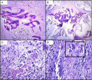 Sección histológica (H/E 4x) A y B) Se visualiza neoplasia intestinal con componente mucinoso y presencia de tejido óseo. Se identifica como áreas intensamente eosinofilias en el área central (rosadas) con estructura trabecular y presencia de osteocitos en lagunas. Se observa además componente mucinoso en las zonas más claras con matriz extracelular laxa, tenuemente basófila rodeando las zonas periféricas al tejido óseo. C y D) Se observan islotes eosinofílicos de fragmentos de matriz osteoide rodeados por tejido mesenquimatoso laxo y células atípicas caracterizadas por presentar núcleos de morfología irregular, hipercromasia y pleomorfismo nuclear (recuadro negro).