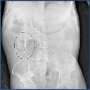 Radiografía simple de abdomen en bipedestación, donde se evidencia un artefacto radiopaco en el cuadrante superior derecho, señalado dentro de la línea punteada.