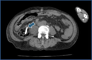 Tomografía computarizada simple de abdomen (corte axial). Se observa un artefacto hiperdenso (flecha), con presencia de gas y líquido libre perilesional.