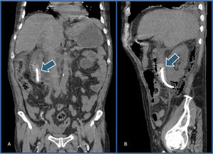 A) Tomografía computarizada simple de abdomen (corte coronal). Se observa un artefacto hiperdenso (flecha), con engrosamiento de la pared duodenal y gas periduodenal. B) Tomografía computarizada simple de abdomen (corte sagital). Se visualiza un artefacto hiperdenso (flecha), con gas disecando hacia el retroperitoneo.