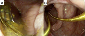 A)Imagen de colonoscopia en la que se visualiza el generador del marcapasos en la luz del colon. B)Imagen de colonoscopia en la que se visualizan los cables del marcapasos ascendiendo hacia la pared colónica.
