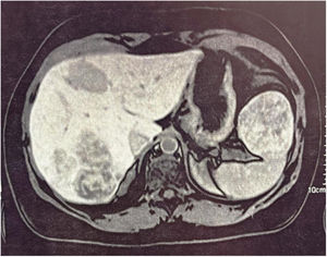 Formación nodular exofítica sólida en el borde superior del bazo, con medidas de 6.3×5.7cm.