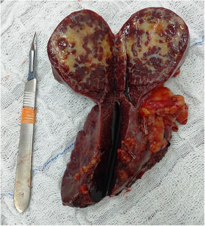 Espécimen quirúrgico con lesión de hemangioendotelioma esplénico.