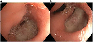 A) Úlcera antral adyacente al píloro de aproximadamente 3cm, que deforma su ingreso. B) La úlcera presentaba una perforación colindante al píloro que permite el paso del instrumento (doble luz).